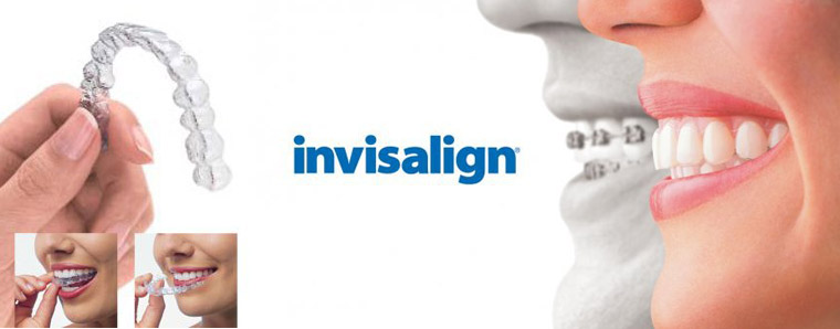 invisalign